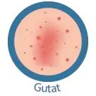 Psoriazis gutat